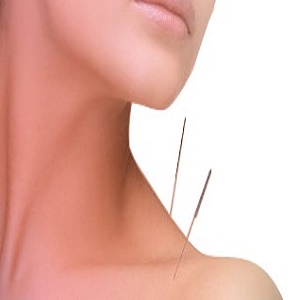 Akupunktura Akupunktura